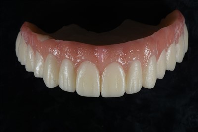 Akril qatroni vaqtinchalik toj