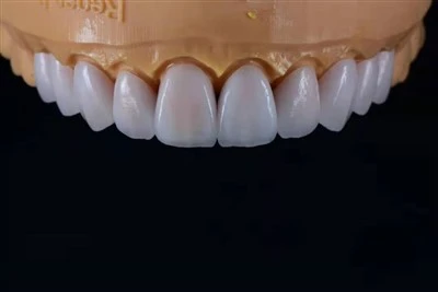 Ultra-Yupqa E.max qatlamli shponlar